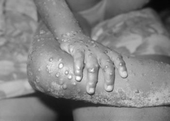 Monkeypox outbreak: FG cautions Nigerians, urges strict adherence to safety measures