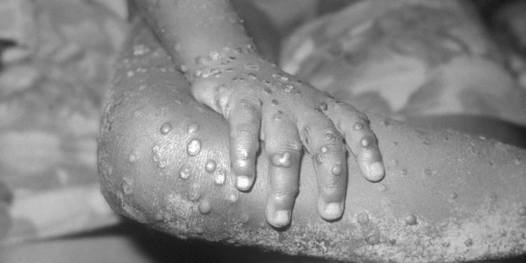 Monkeypox outbreak: FG cautions Nigerians, urges strict adherence to safety measures