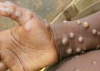Monkey pox: Plateau records 2 positive cases