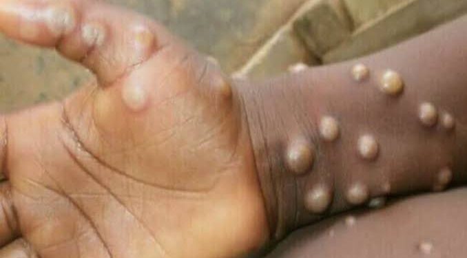 Monkey pox: Plateau records 2 positive cases