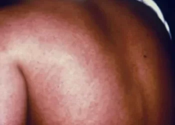 Act now to prevent Marburg virus outbreak