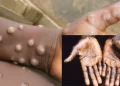Monkeypox spreads to 27 states, cases hit 172
