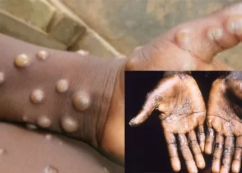 Monkeypox spreads to 27 states, cases hit 172