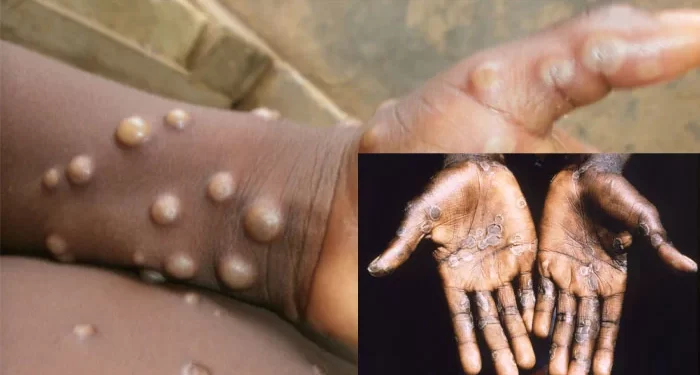 Monkeypox spreads to 27 states, cases hit 172