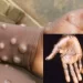 Monkeypox spreads to 27 states, cases hit 172